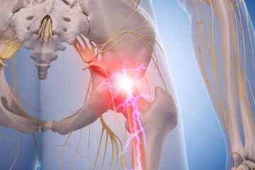 sciatic-nerve-pain