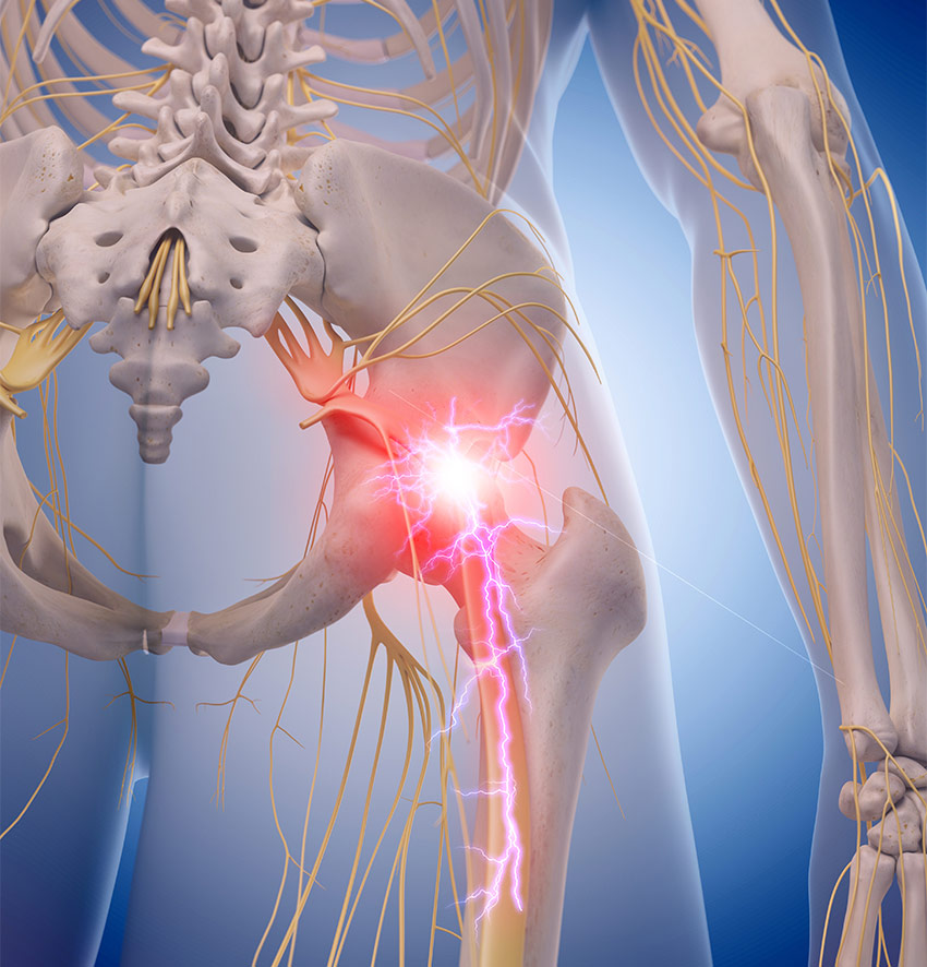 sciatic-nerve-pain